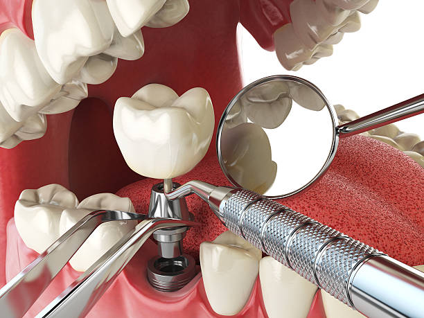 Best Emergency Treatment for Toothache in Kenton, OH